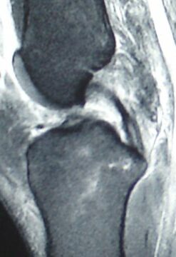 rupture croisé formation DPC